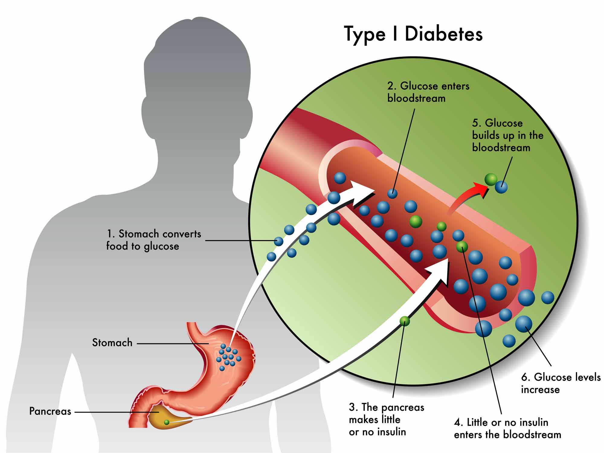 Type 1 Diabetes Type 1 Diabetes