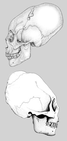 Cranial Deformations