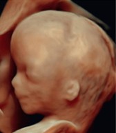 3-D Ultrasound 3-D Ultrasound