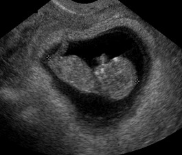 Fetal Ultrasound Fetal Ultrasound