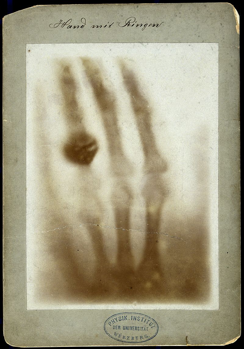 X-ray image of a human hand by Wilhelm Conrad Röntgen